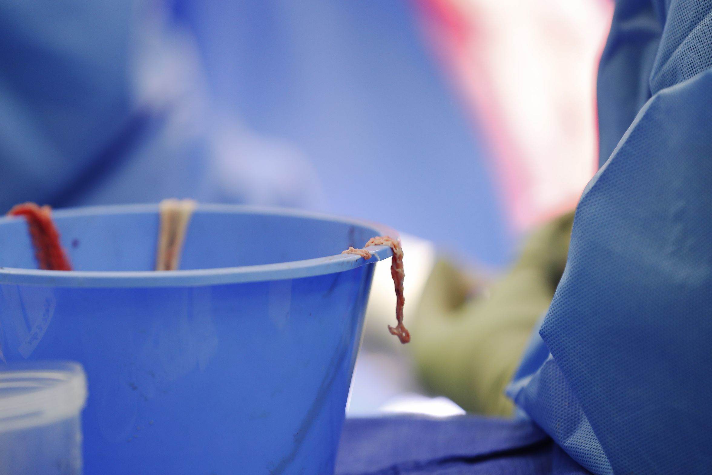 Harvested skin from Isabella McCune's back is ready for transplanting to her legs during surgery at the Arizona Burn Center in Phoenix May 24, 2018. She was severely burned in a home accident in March.