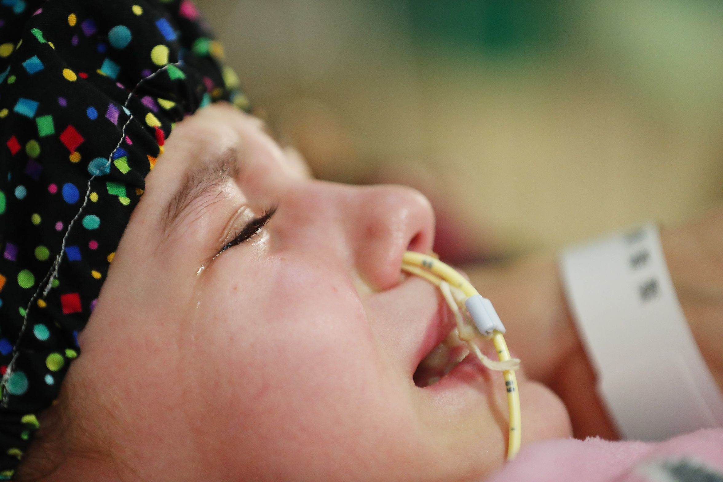 Isabella McCune cries at the thought of intubation before her surgery at the Arizona Burn Center in Phoenix May 24, 2018. She was severely burned in a home accident in March.